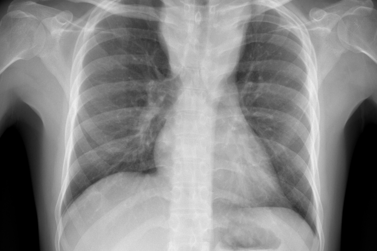 Csökkent a tbc-fertőzések száma Európában